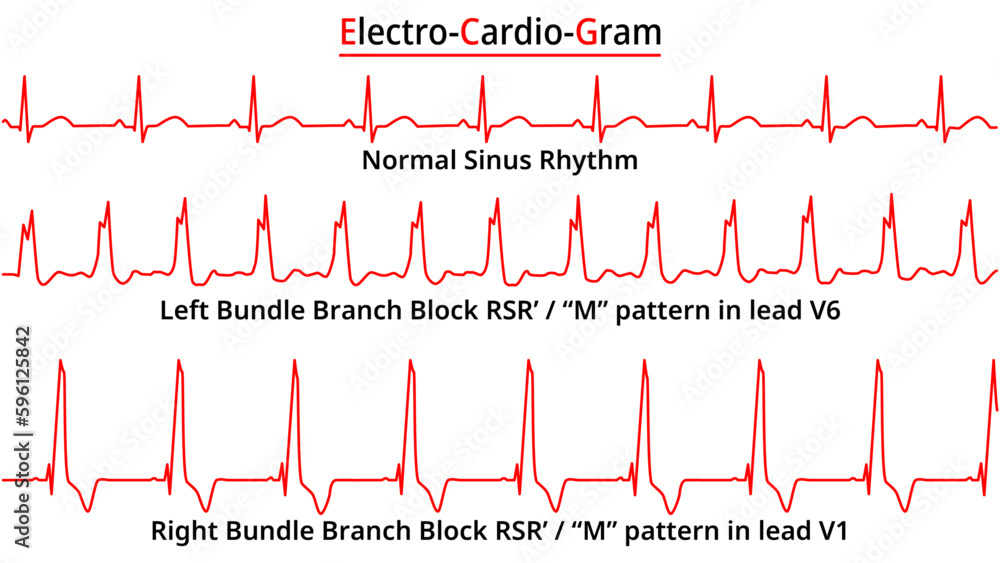 Right Vs Left Bundle Branch Block Ecg Right Vs Left Bundle Branch Block Ecg